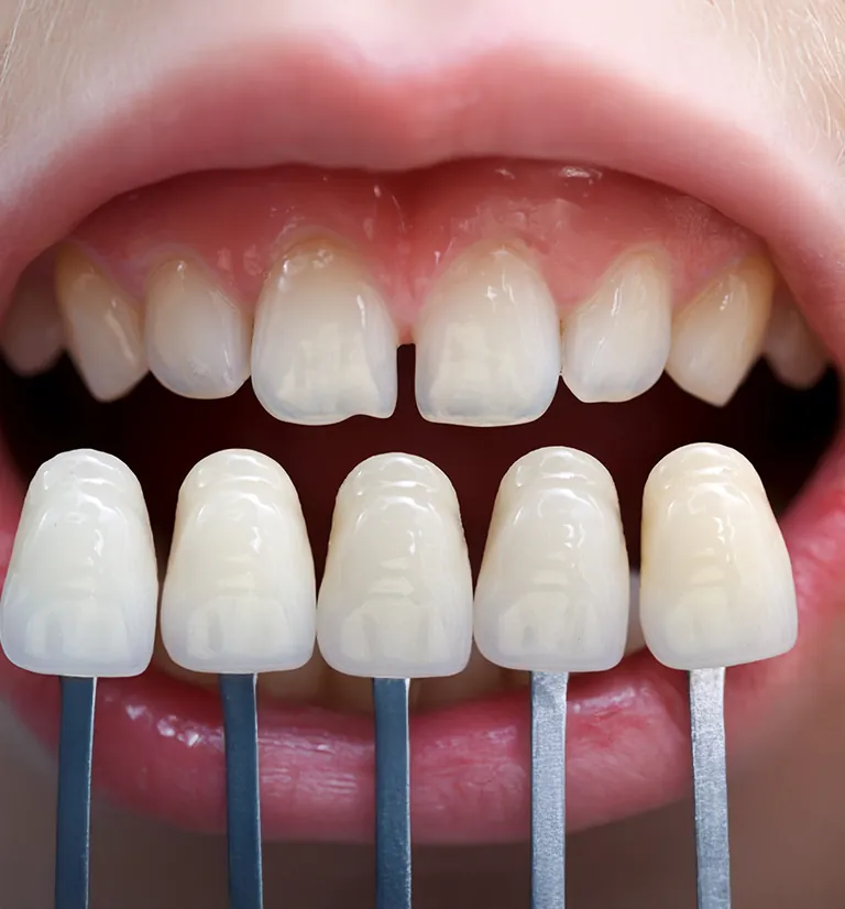 Ilustração do tratamento: Lente de contato dental